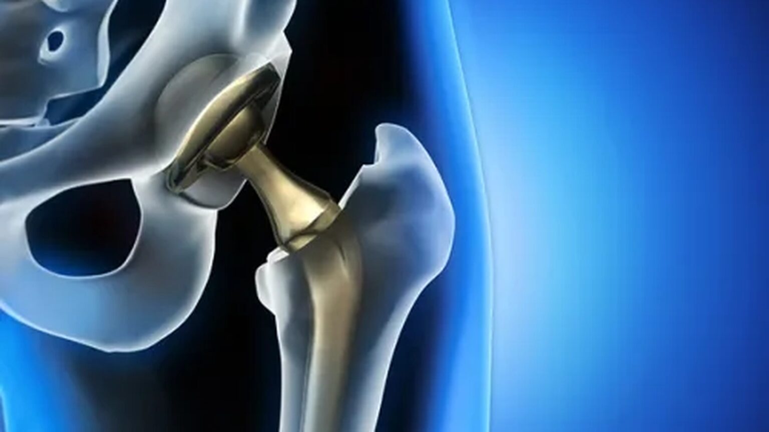 Robotic Hip Replacement Surgery in India | Dr. Balaraju Naidu